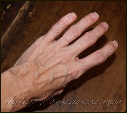 Rheumatoid Arthritis hands