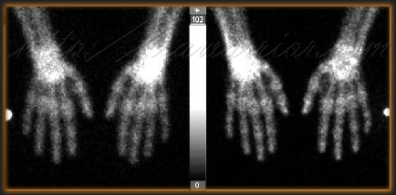 nuclear bone scan hands & wrists