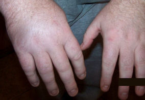 RA swollen fingers