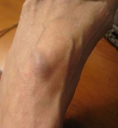 swollen blood vessel on foot with Rheumatoid Disease