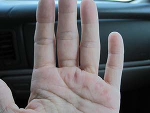 swollen fingers Rheumatoid Disease