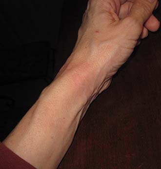 swollen wrist Rheumatoid Disease