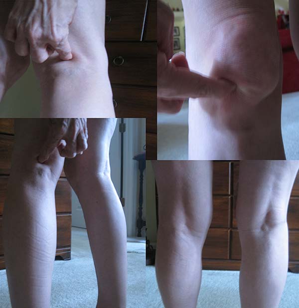 swollen knees Rheumatoid Arthritis / Rheumatoid Disease 
