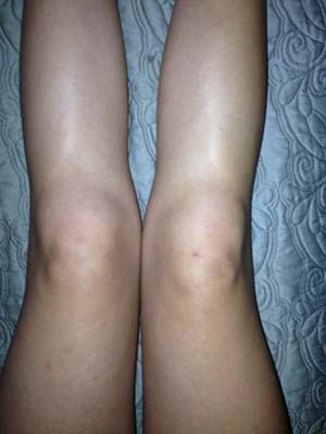 juvenile rheumatoid knees swelling
