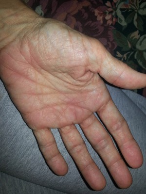 swollen hand with rheumatoid