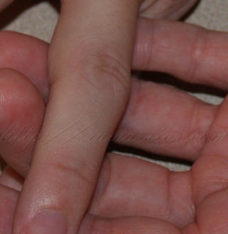 swollen finger