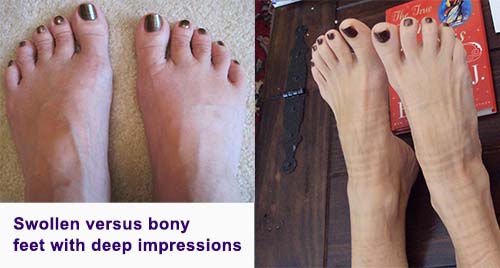 swollen versus bony feet Rheumatoid Disease