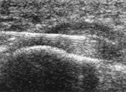 ultrasound foot plantar fasciitis