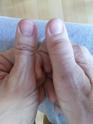 swollen rt thumb joints