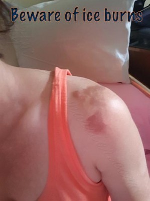 shoulder burns from ice pack
